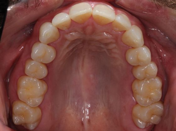 Invisalign (Clear Aligners): Lip Biting - Before