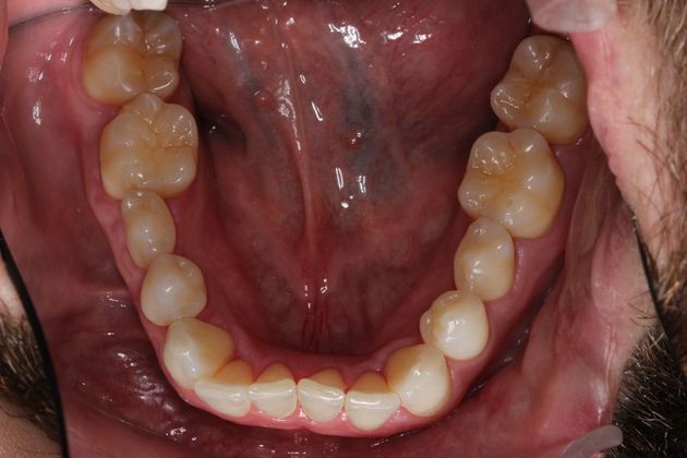 Invisalign (Clear Aligners): Lip Biting - Before