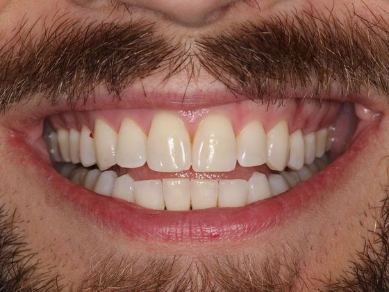 Invisalign (Clear Aligners) Lip Biting - After