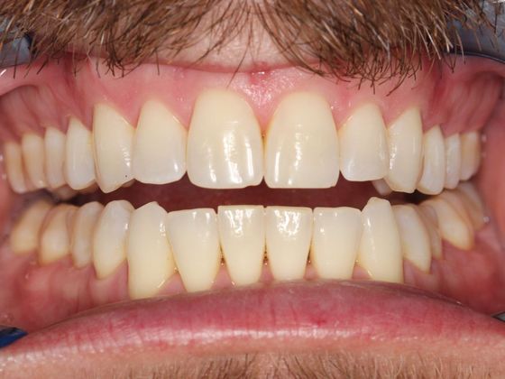 Invisalign (Clear Aligners): Lip Biting - After