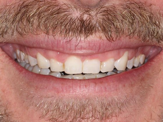 Smile Makeover Uneven Gums - Before