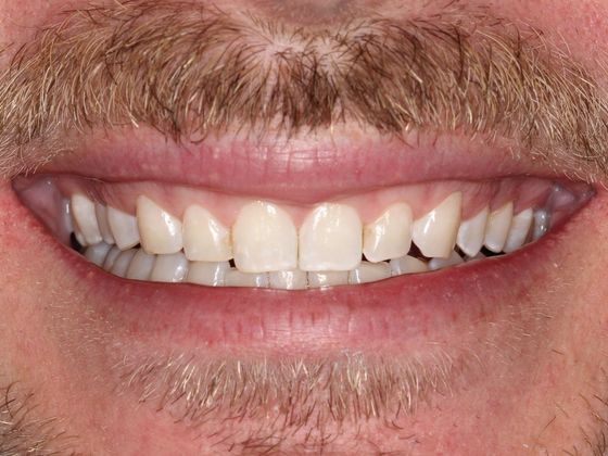 Smile Makeover Uneven Gums - After