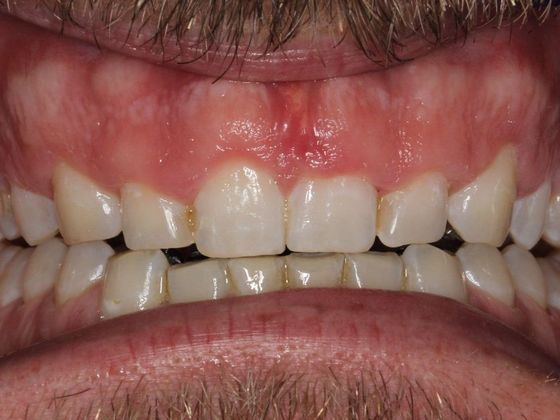 Smile Makeover: Uneven Gums - Before
