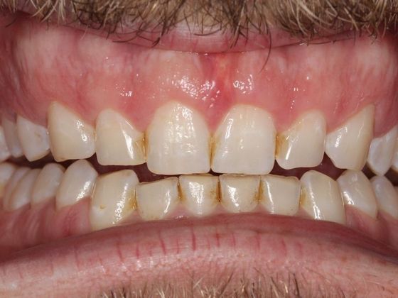 Smile Makeover: Uneven Gums - After