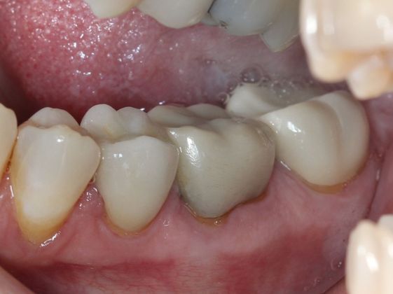 Cosmetic Dentistry: Old fillings - After