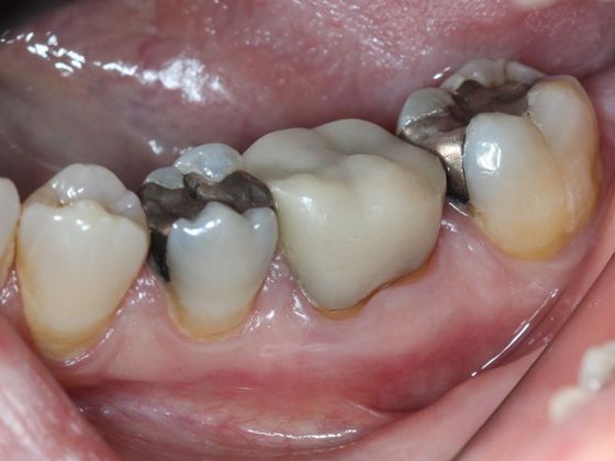 Cosmetic Dentistry: Old fillings - Before