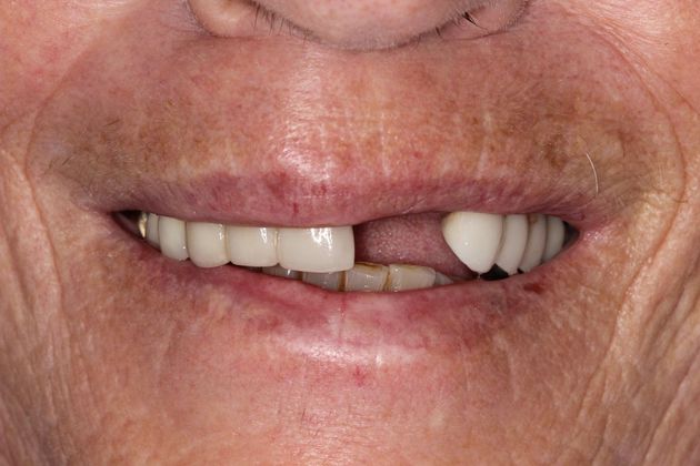 Smile Makeover Tooth Fracture - Before