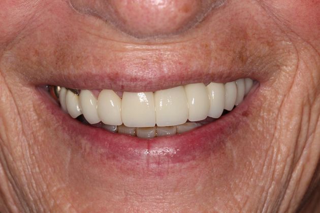 Smile Makeover Tooth Fracture - After
