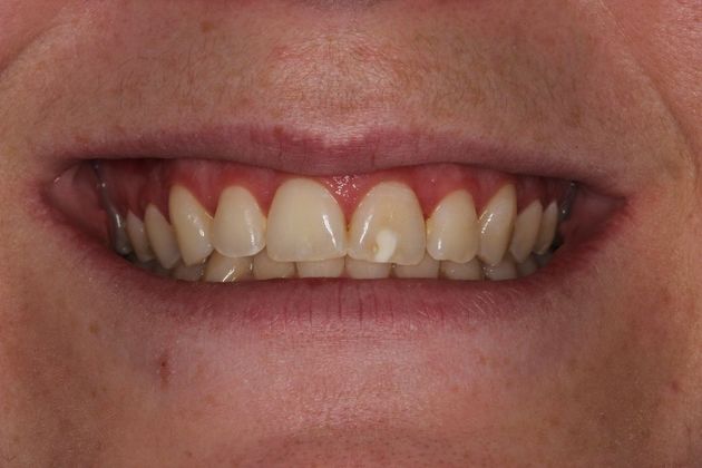 Cosmetic Dentistry White Spots can Disappear - Before