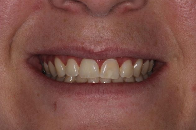 Cosmetic Dentistry White Spots can Disappear - After