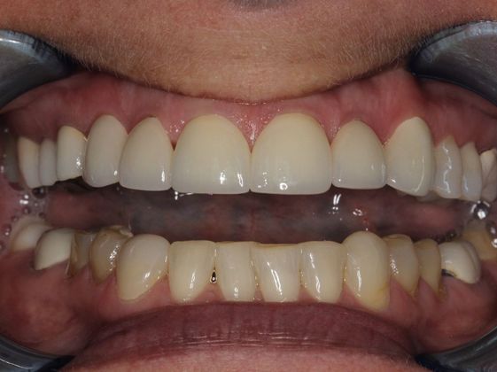 Full Mouth Rehabilitation: Digital Planning - After