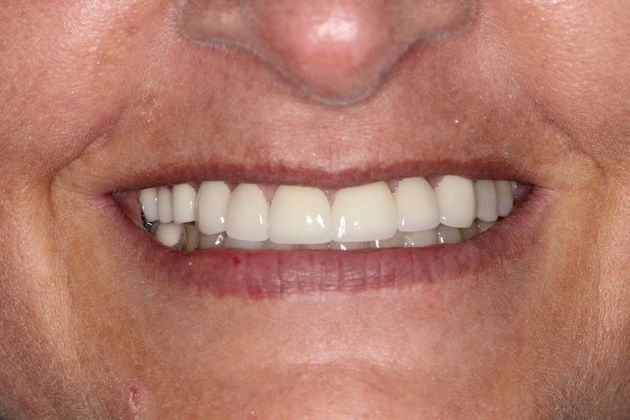 Full Mouth Rehabilitation Digital Planning - After