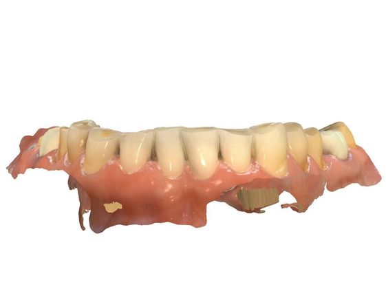 Full Mouth Rehabilitation: Digital Planning - Before