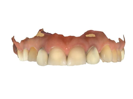 Full Mouth Rehabilitation: Digital Planning - Before