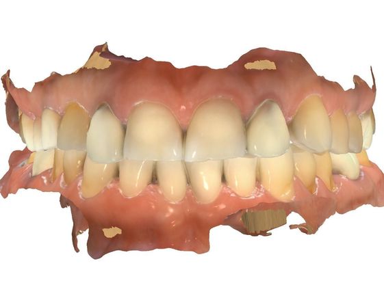 Full Mouth Rehabilitation: Digital Planning - Before
