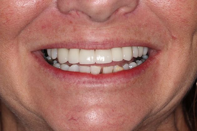 Full Mouth Rehabilitation: Life Changes - After