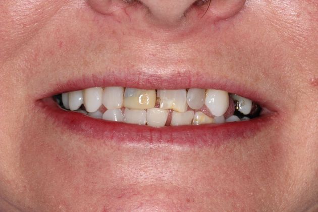 Full Mouth Rehabilitation: Life Changes - Before