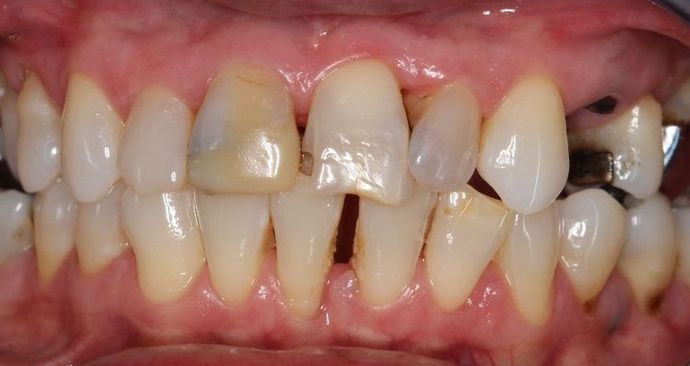 Full Mouth Rehabilitation: Life Changes - Before