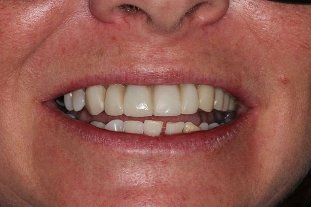 Full Mouth Rehabilitation: Life Changes - Temporary restorations for healing/diagnosis