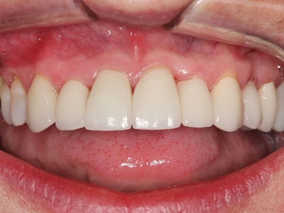 Full Mouth Rehabilitation: Life Changes - After