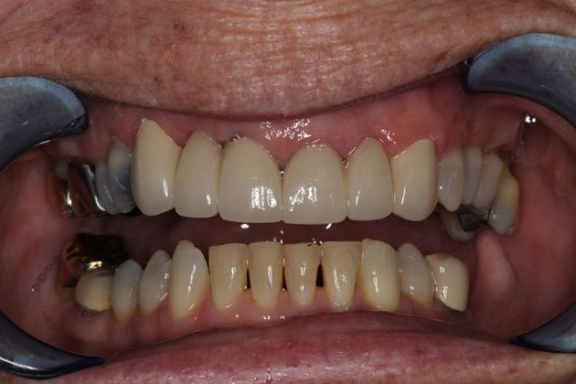 Smile Makeover: Front Teeth Breakdown - After
