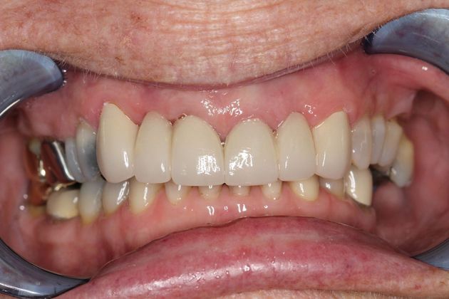 Smile Makeover: Front Teeth Breakdown - After