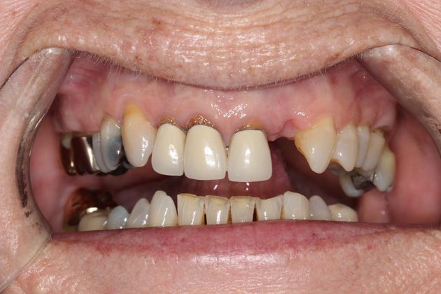 Smile Makeover: Front Teeth Breakdown - Before