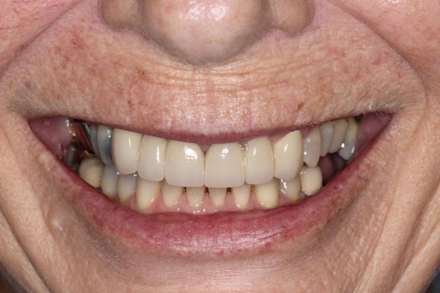 Smile Makeover Front Teeth Breakdown - After