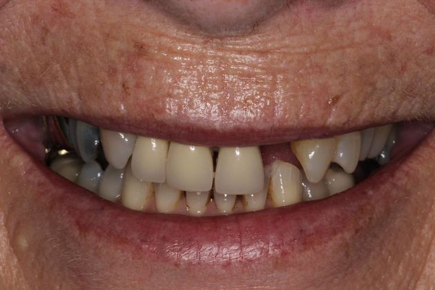 Smile Makeover Front Teeth Breakdown - Before