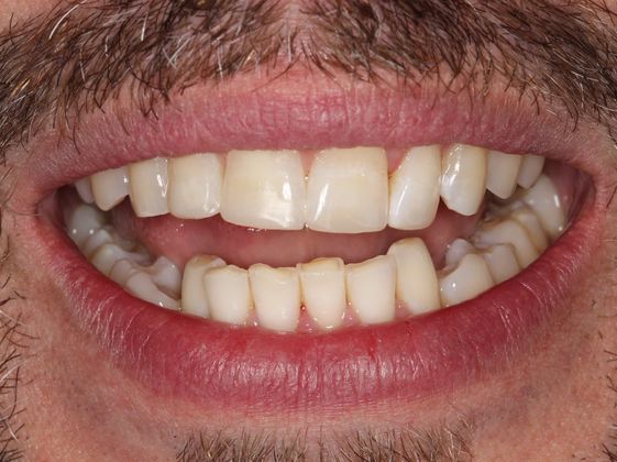 Bonding: Chipped Front Teeth - Before