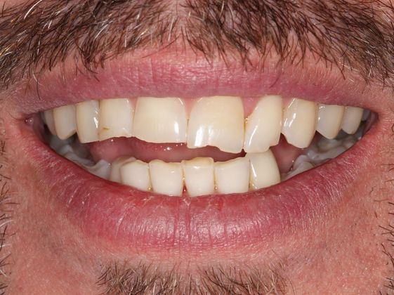 Bonding: Chipped Front Teeth - After