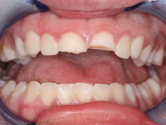 Bonding: Tooth Trauma - Before