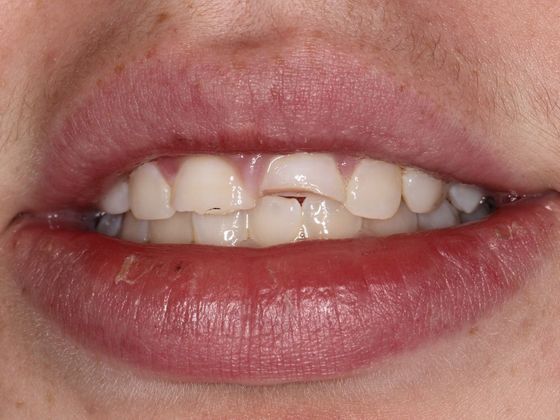 Bonding: Tooth Trauma - Before