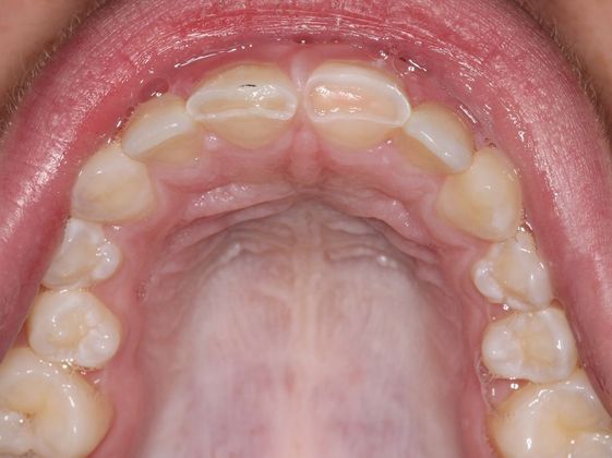 Bonding: Tooth Trauma - Before