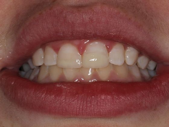 Bonding: Tooth Trauma - After