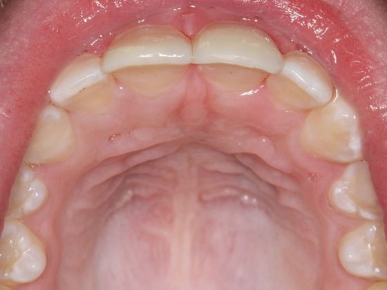 Bonding: Tooth Trauma - After