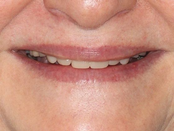 Bonding: Invisible Teeth - After