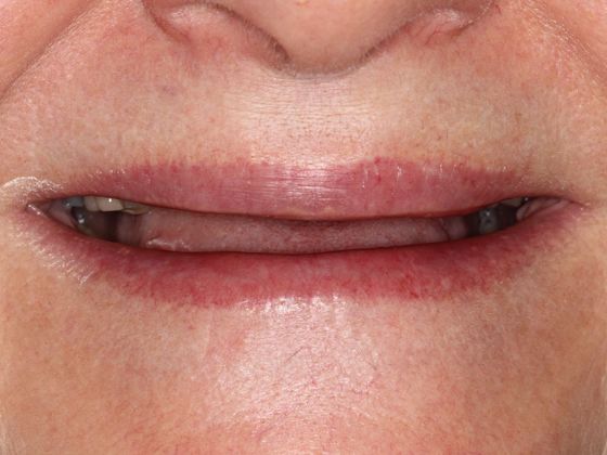 Bonding: Invisible Teeth - Before