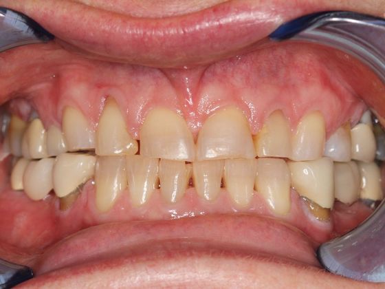 Bonding: Invisible Teeth - Before