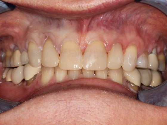 Bonding: Invisible Teeth - After