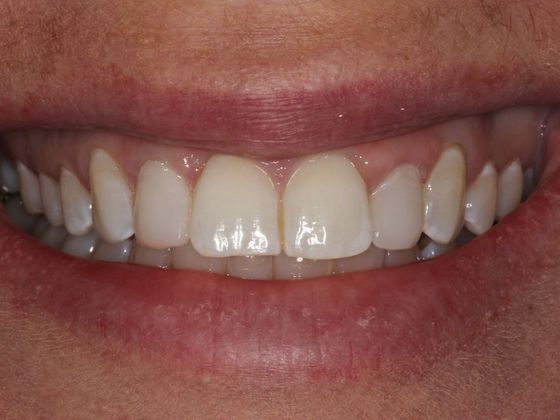 Bonding Small Changes, Big Difference - After