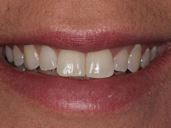 Bonding Small Changes, Big Difference - Before