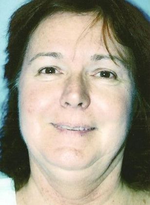 Chin Augmentation Case 5 - Before