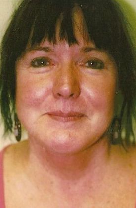 Chin Augmentation Case 5 - After