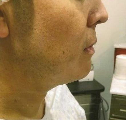 Chin Augmentation: Case 7 - Before