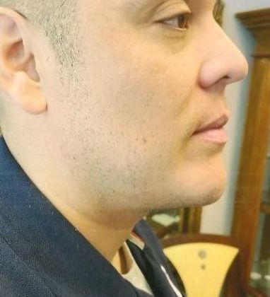 Chin Augmentation: Case 7 - After