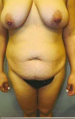 Mommy Makeover Case 7 - Before