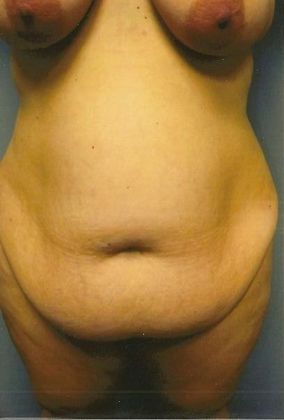 Mommy Makeover: Case 9 - Before