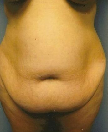 Tummy Tuck: Case 11 - Before
