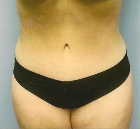 Tummy Tuck: Case 11 - After